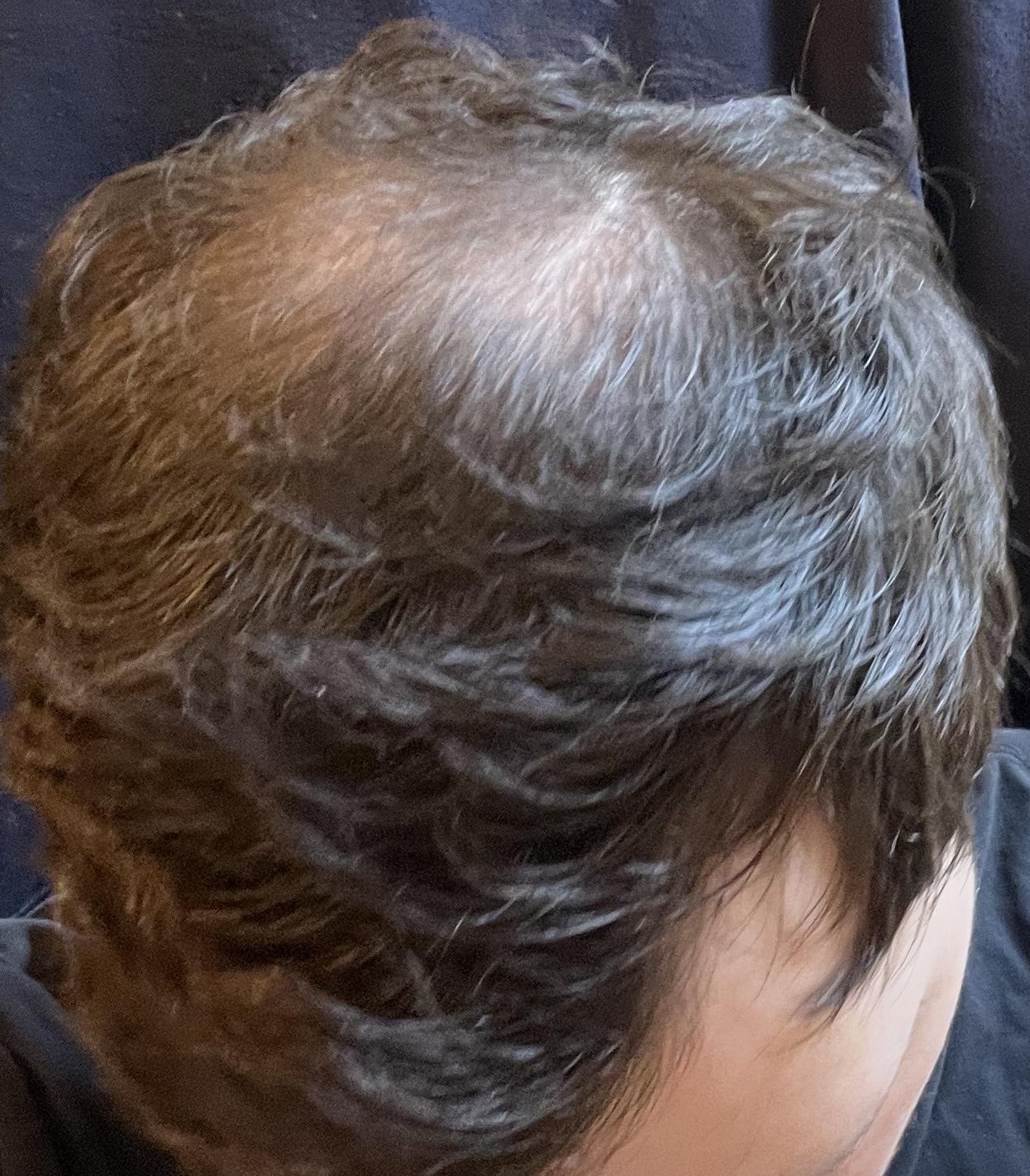 Verlaufsfoto des Haarwirbels vom 29. Mai 2026 während meines iRestore Professional Tests