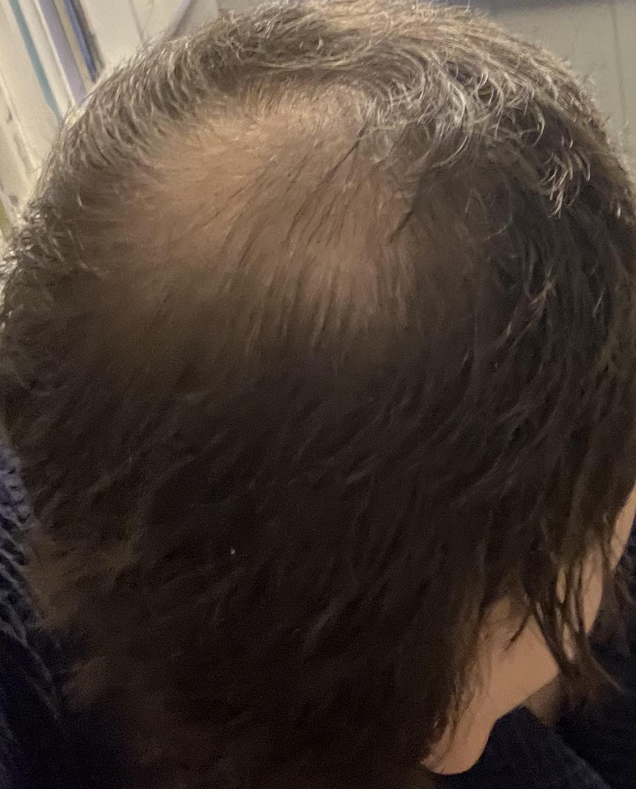 Verlaufsfoto des Haarwirbels vom 1. Juni 2026 während meines iRestore Professional Tests