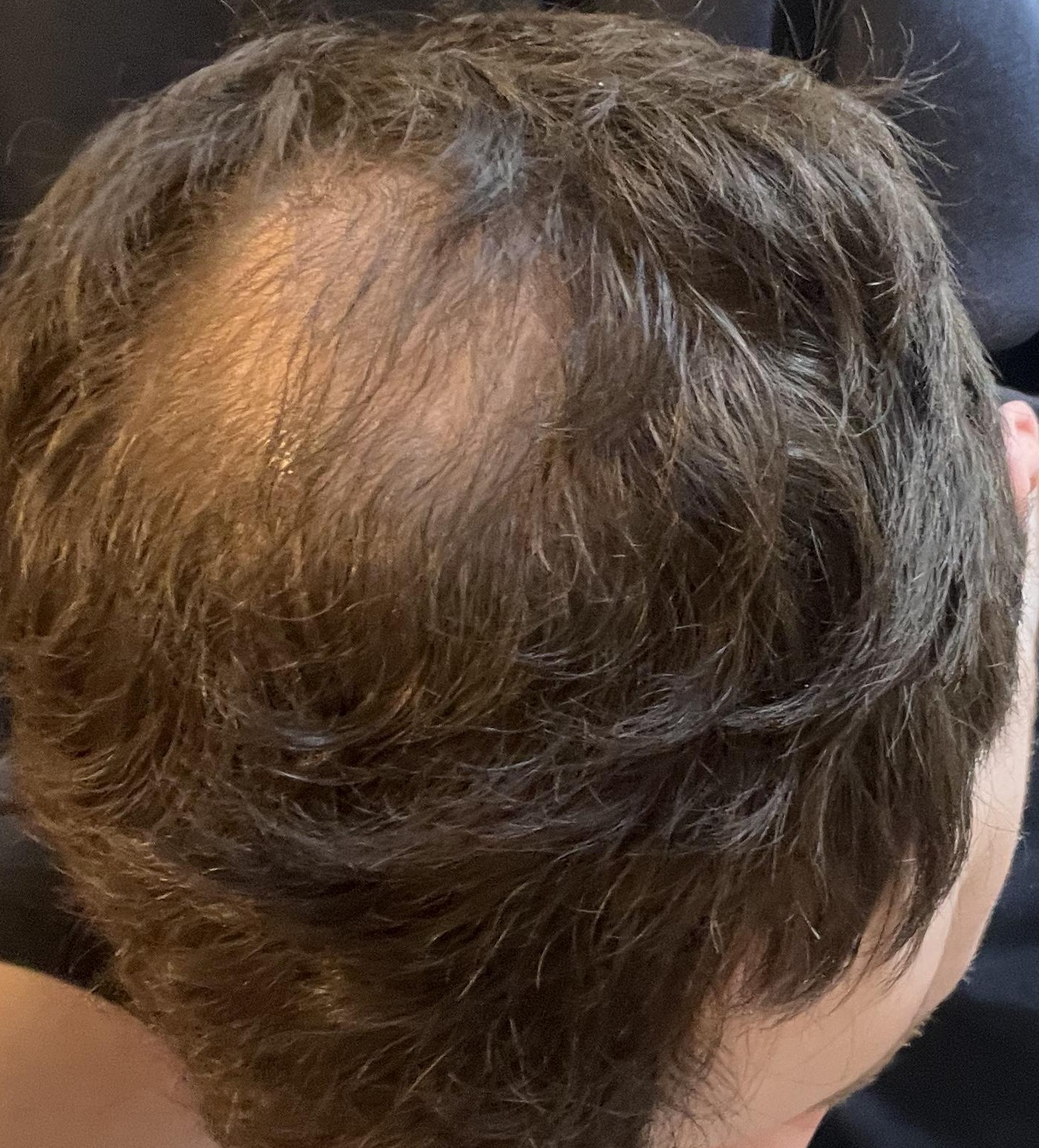Verlaufsfoto des Haarwirbels vom 13. Juni 2026 während meines iRestore Professional Tests