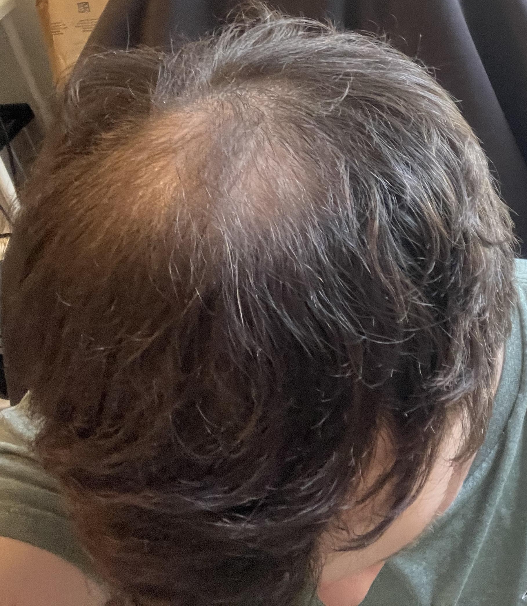 Verlaufsfoto des Haarwirbels vom 8. Juli 2026 während meines iRestore Professional Tests