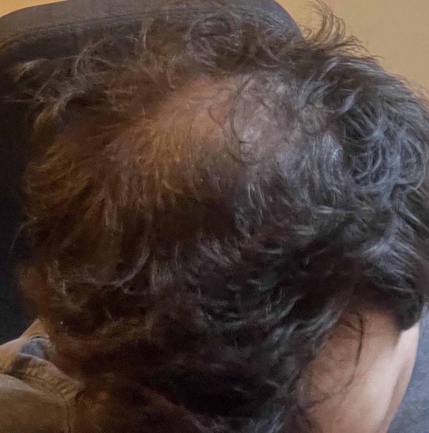 Verlaufsfoto des Haarwirbels vom 25. August 2026 während meines iRestore Professional Tests