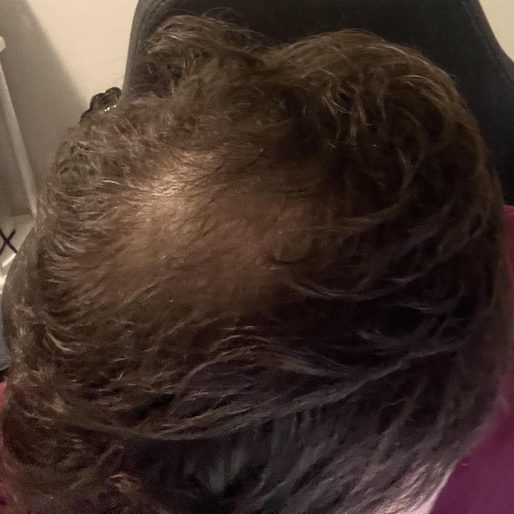 Verlaufsfoto des Haarwirbels vom 1. Oktober 2026 nach etwa fünf Monaten iRestore Professional Nutzung